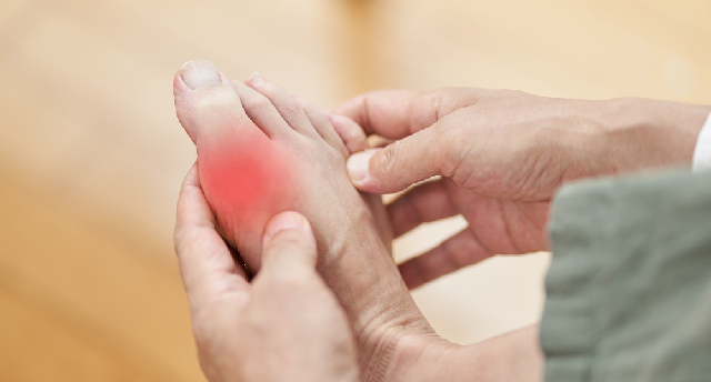 acute gout flare clinical trial