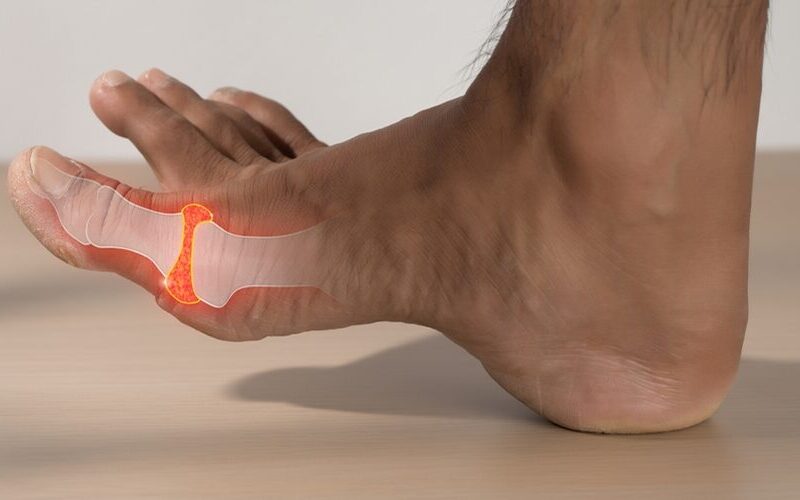 Stages of Gout