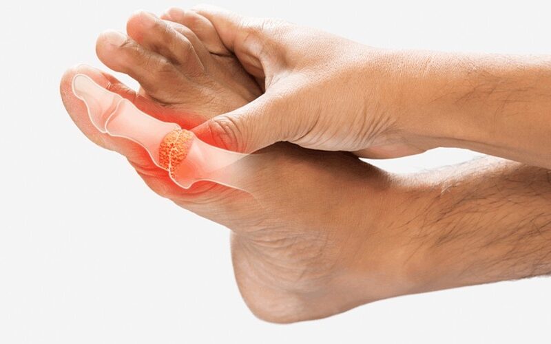 What Is Gout