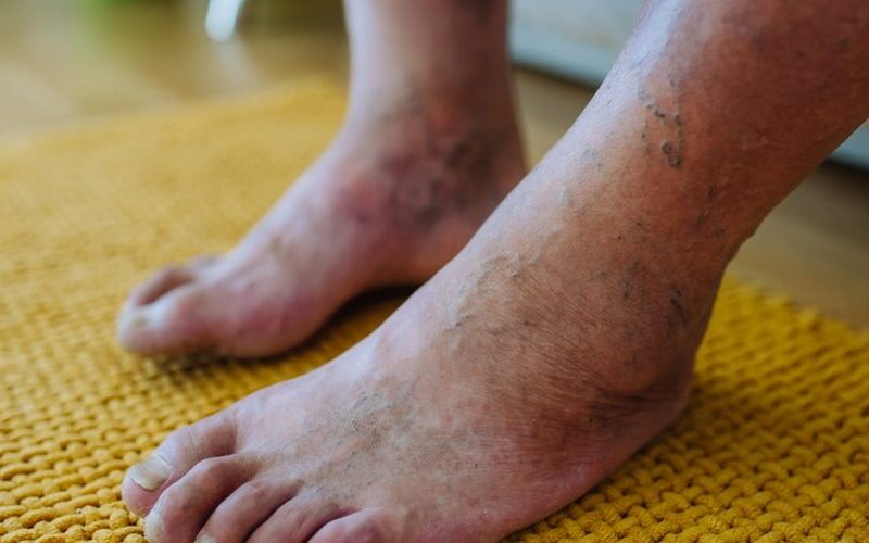 diabetic foot ulcer