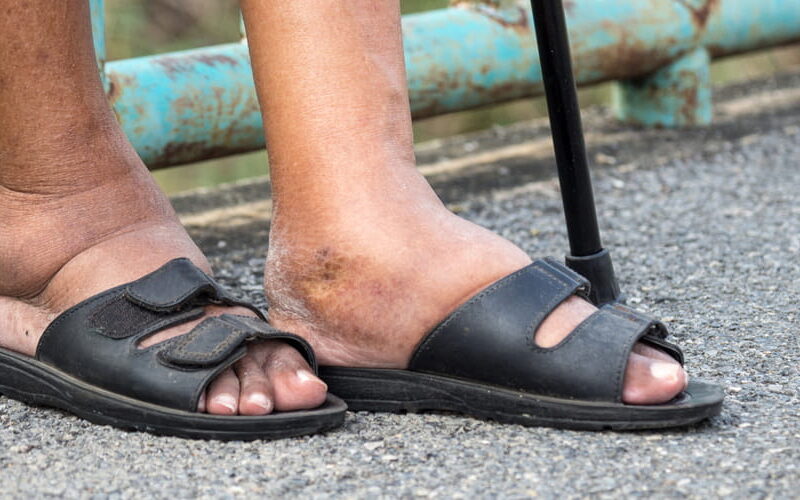 Non-Diabetic vs Diabetic Foot Ulcers