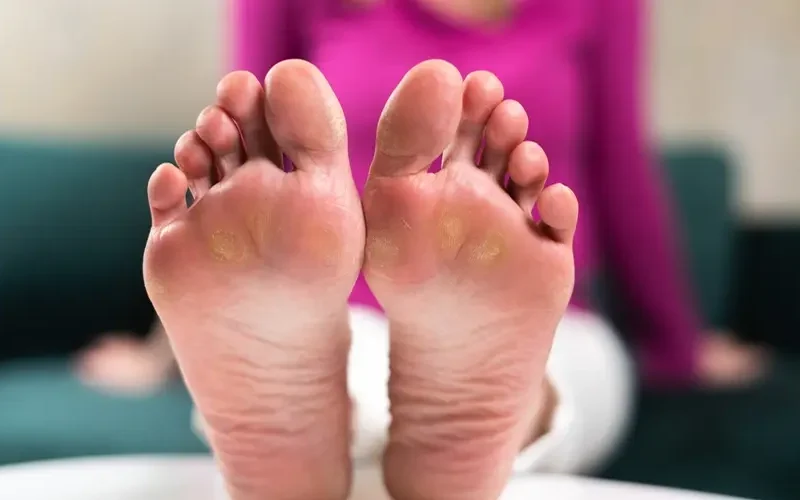 Diabetic Foot Ulcer Stages