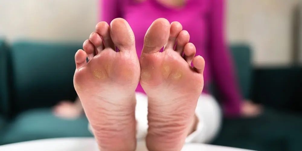 Diabetic Foot Ulcer Stages