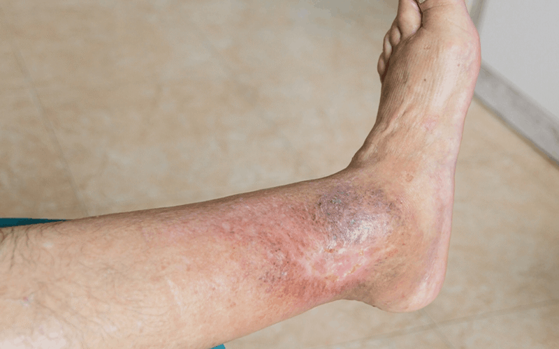 Is Diabetic Foot Ulcer Dangerous