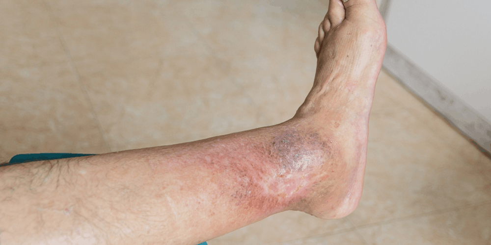 Is Diabetic Foot Ulcer Dangerous