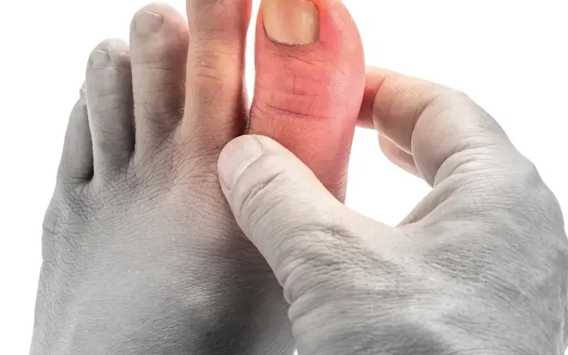 10 minute gout cure