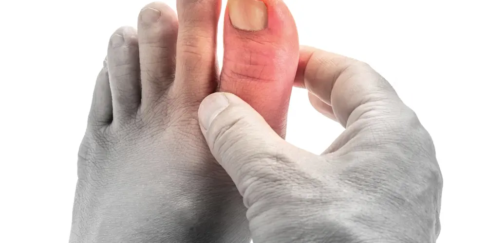 10 minute gout cure